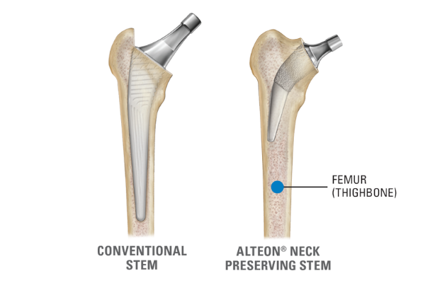 This image shows the difference between a conventional stem and Advita's Alteon neck preserving stem