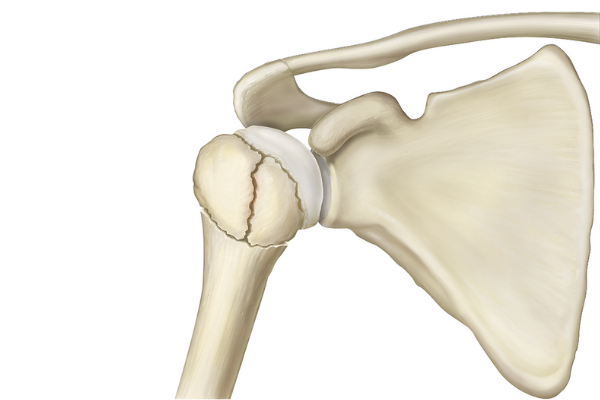 Image showing locations of proximal humerus fractures