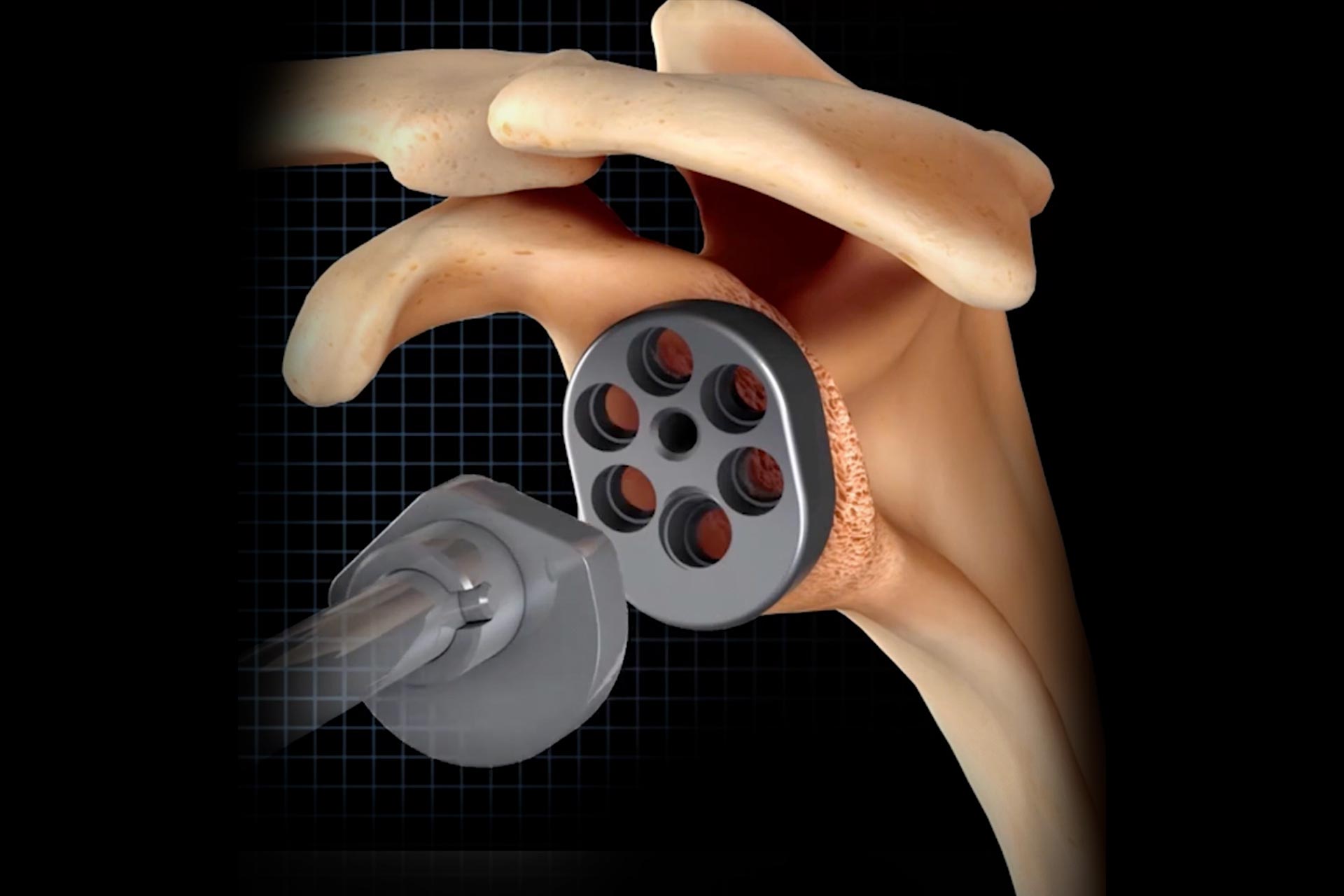 Is wedge augmentation better than eccentric reaming in RSA?