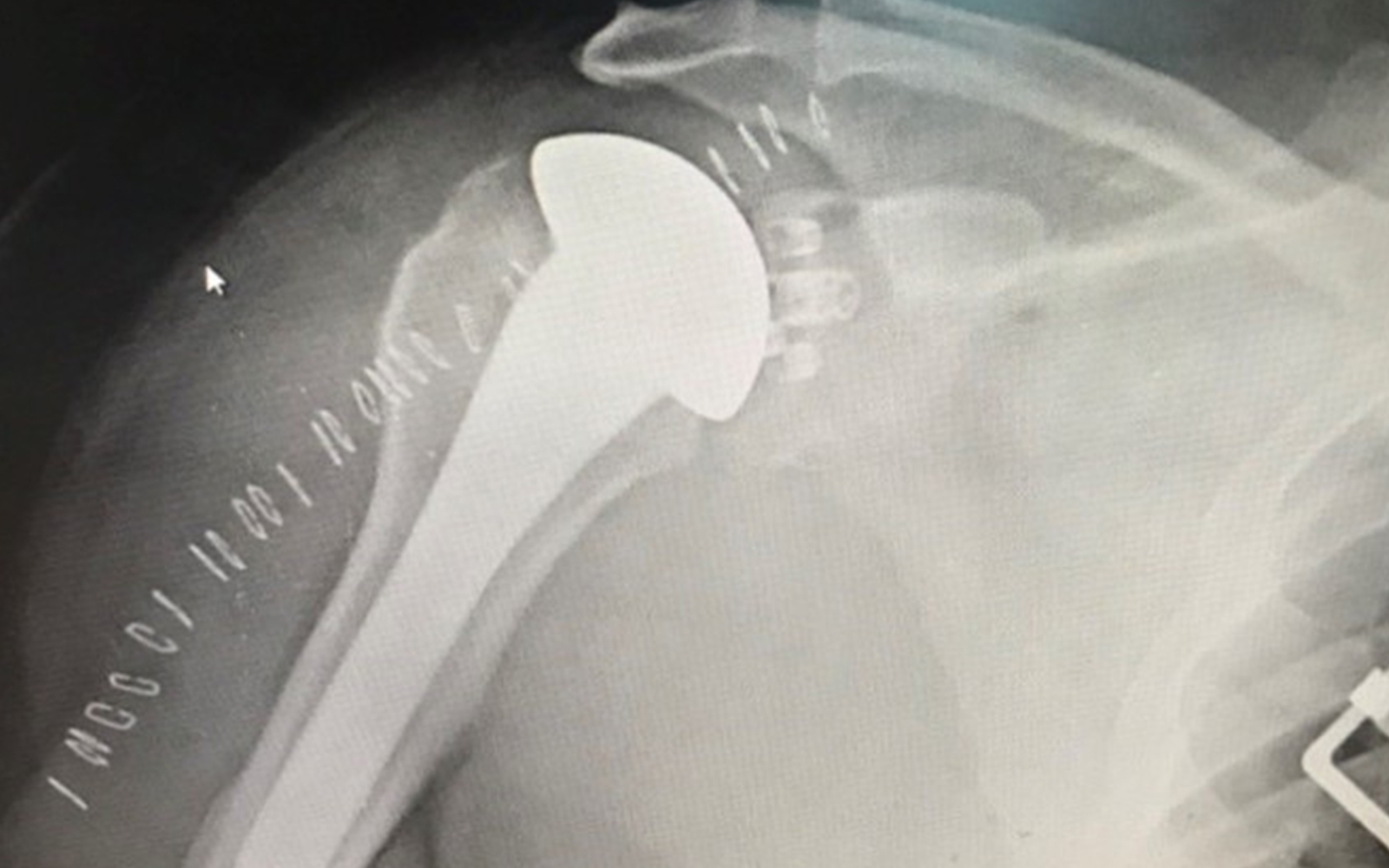 Shoulder Revision with a Platform System