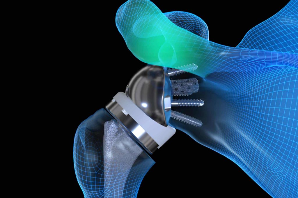 Complication of Reverse Shoulder Arthroplasty