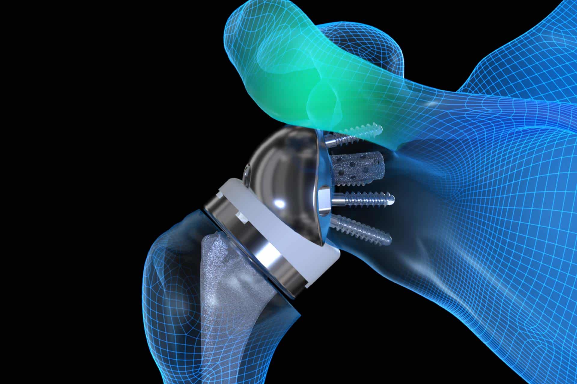 Complication of Reverse Shoulder Arthroplasty