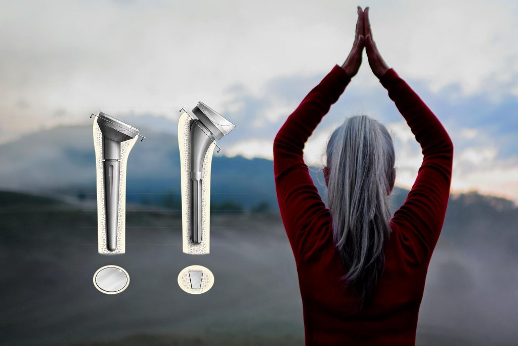Review of “Reverse shoulder arthroplasty for patients with cuff tear arthropathy: do clinical outcomes differ by inlay vs. onlay design?”
