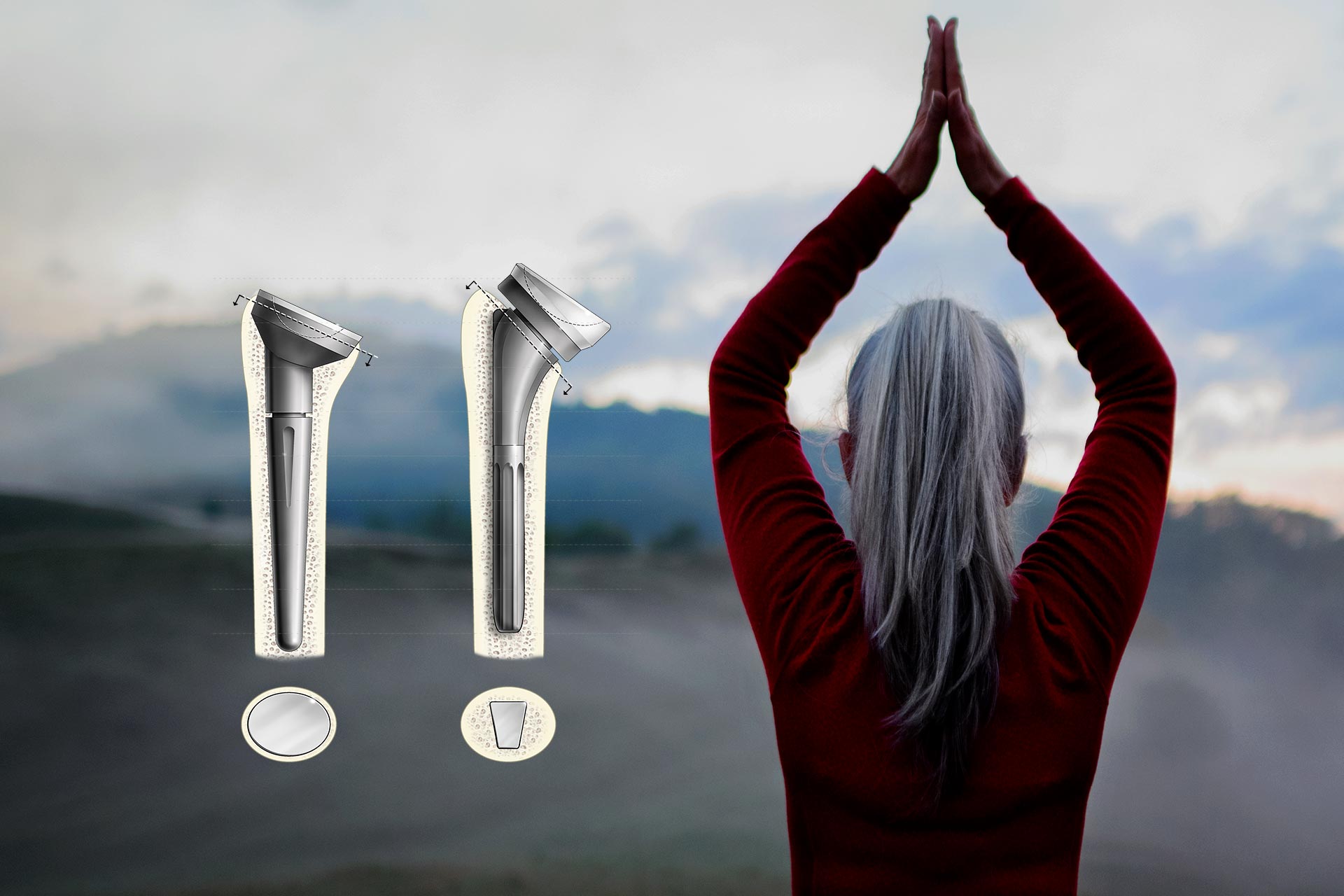 Review of “Reverse shoulder arthroplasty for patients with cuff tear arthropathy: do clinical outcomes differ by inlay vs. onlay design?”