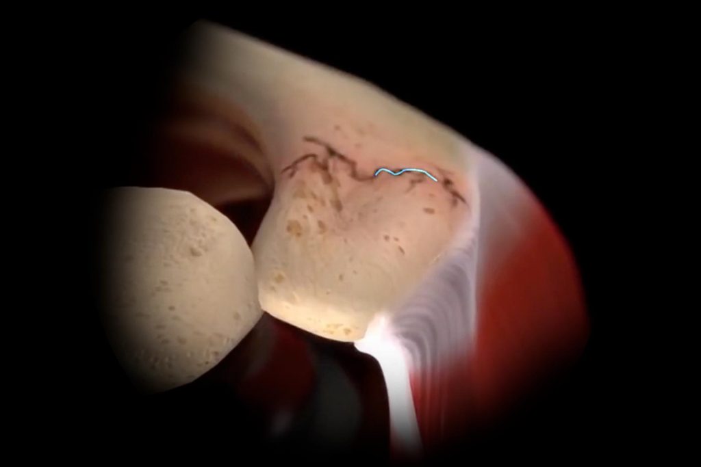 Review of Acromial and Scapular Fractures After Reverse Shoulder Arthroplasty: Inlay vs. Onlay Component Designs Fracture Shoulder Illustration