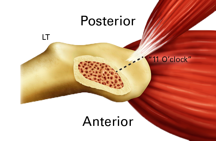 direct anterior approach for total hip arthroplasty hip illustration
