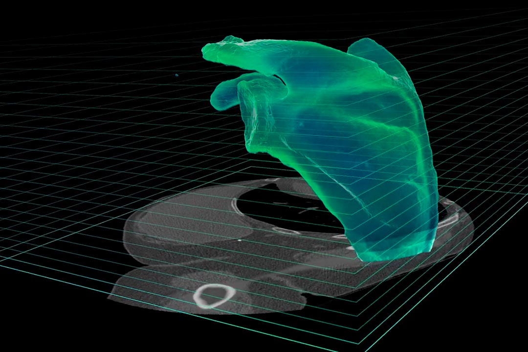Advita Ortho Navigation Total Shoulder Arthroplasty